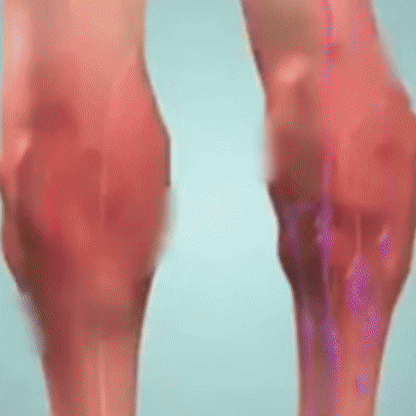 VARICOSE VEINS OINTMENT | Crema tratamiento de varices| Mejora la apariencia de arañitas | Uso diario unisex