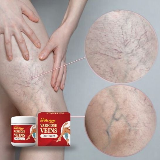 VARICOSE VEINS OINTMENT | Crema tratamiento de varices| Mejora la apariencia de arañitas | Uso diario unisex