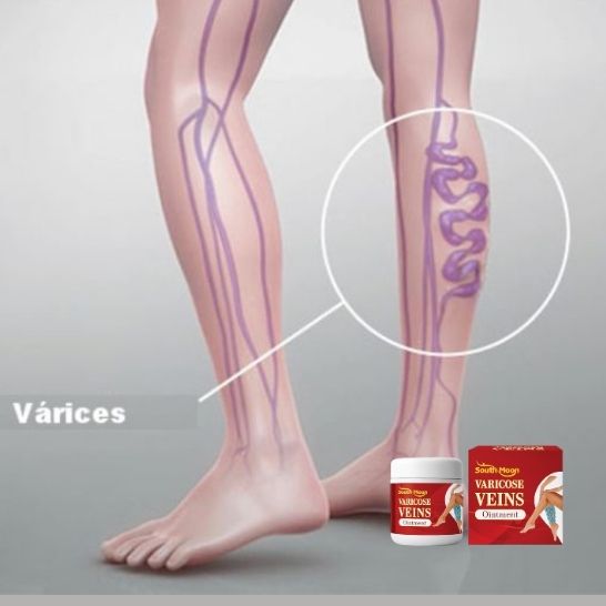 VARICOSE VEINS OINTMENT | Crema tratamiento de varices| Mejora la apariencia de arañitas | Uso diario unisex