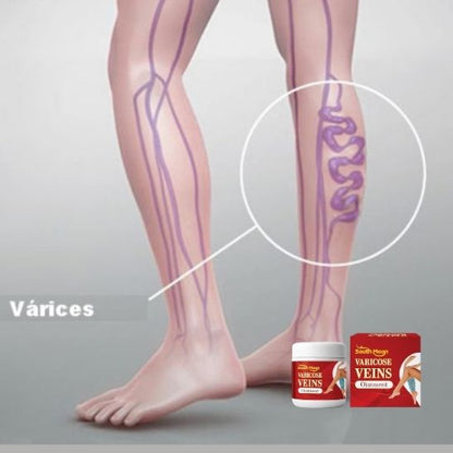 VARICOSE VEINS OINTMENT | Crema tratamiento de varices| Mejora la apariencia de arañitas | Uso diario unisex