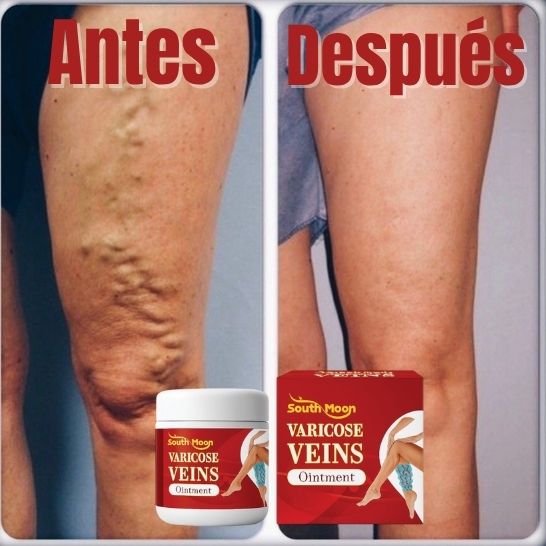 VARICOSE VEINS OINTMENT | Crema tratamiento de varices| Mejora la apariencia de arañitas | Uso diario unisex